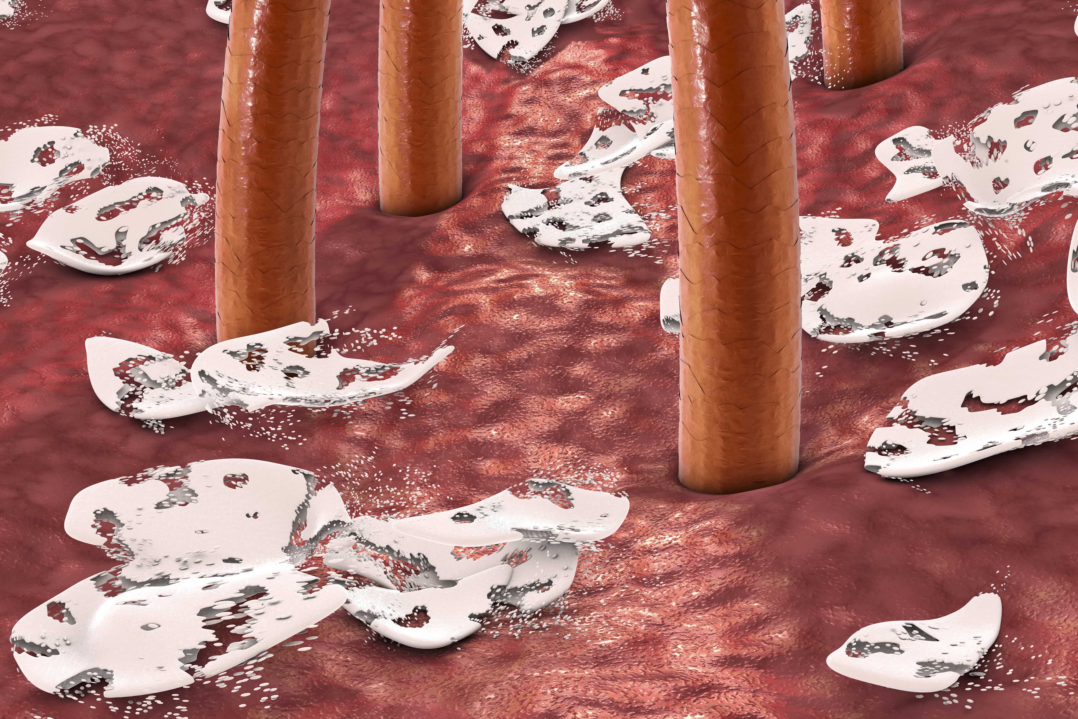 頭皮の雑菌の繁殖