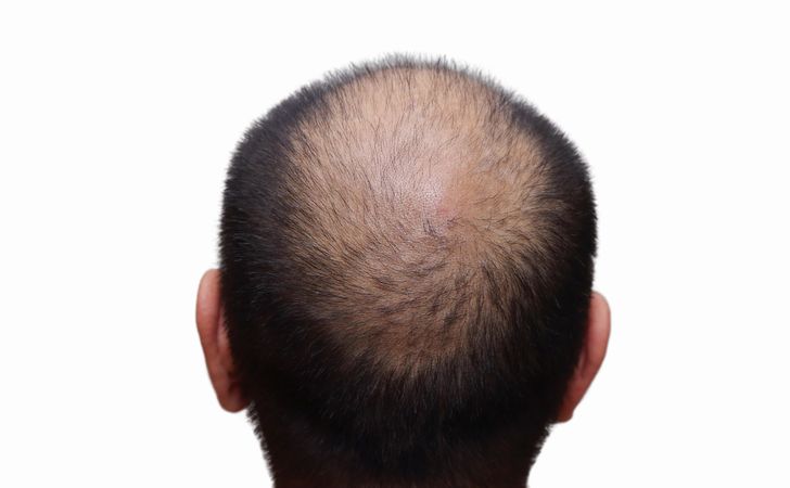 頭頂部が薄くなっている男性の後ろ姿