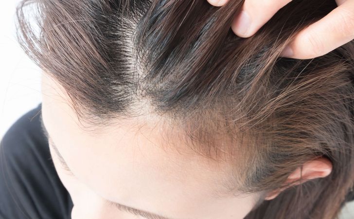 脱毛症が関係している?